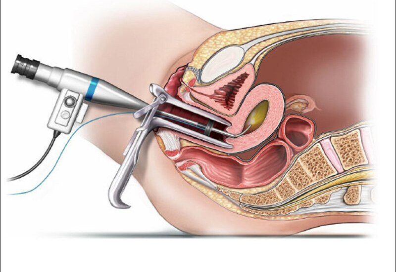 What is Hysteroscopy Treatment